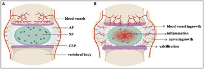 Intervertebral disc degeneration—Current therapeutic options and challenges